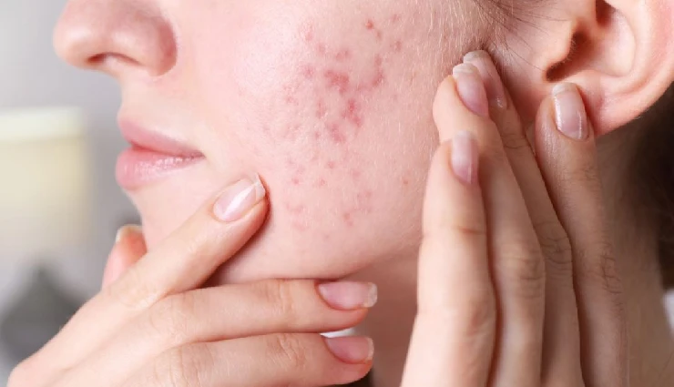 benefits of yogurt for skin and hair,yogurt for glowing skin,yogurt for tan removal,yogurt for skin exfoliation,yogurt face pack benefits,yogurt for dandruff treatment,yogurt for frizz-free hair,yogurt hair mask benefits,yogurt for strong hair roots,diy beauty remedies with yogurt