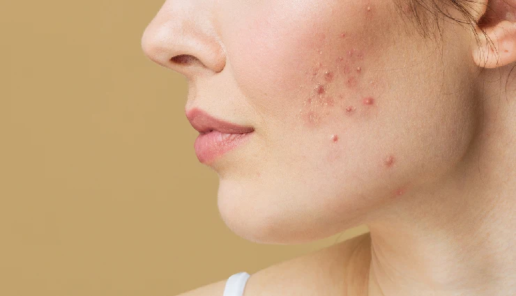 benefits of oats for skin and hair,oats for glowing skin,oats for acne treatment,oats natural moisturizer,oats face pack benefits,oats for frizz-free hair,oats for itchy scalp relief,oats hair mask benefits,oats beauty remedies,diy beauty care with oats