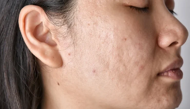 egg benefits for skin,egg benefits for hair,egg white face mask,egg yolk for dry skin,egg for hair growth,egg hair mask,protein treatment with eggs,egg for glowing skin,egg for oily skin control,natural egg remedies for beauty