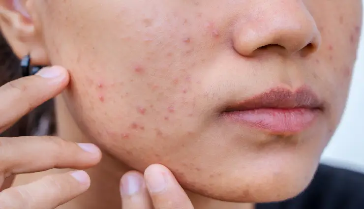 mint leaves benefits,pudina for skin,pudina for hair,mint for acne,natural dandruff remedy,mint cooling effect,herbal skincare tips,natural hair growth remedies,diy mint face pack,chemical-free beauty care