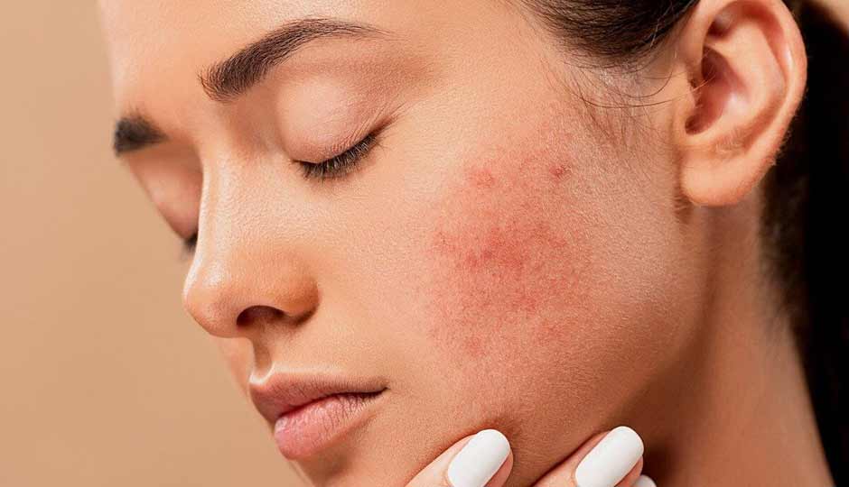 15 Effective Home Remedies to Treat Acne on Face Naturally
