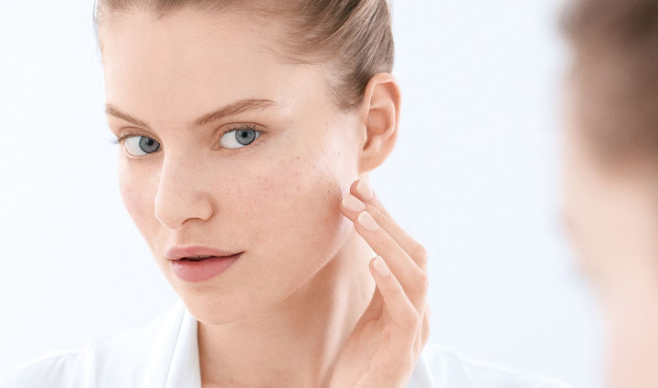 acne breakout,reasons for acne breakout,acne,skin care tips,beauty tips,summer tips