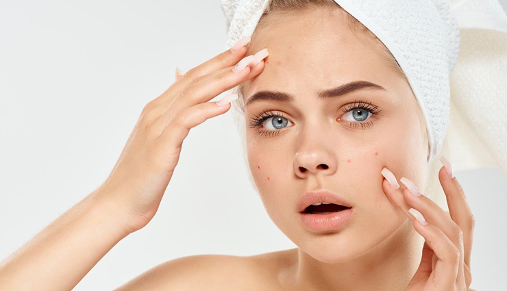 home remedies,home remedies for acne,skin care tips,beauty tips