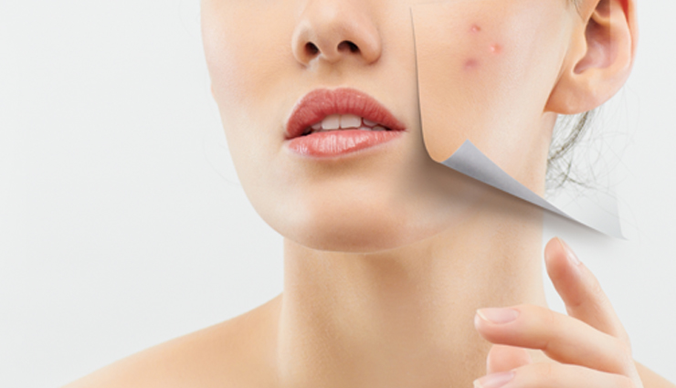 home remedies,home remedies for acne,skin care tips,beauty tips