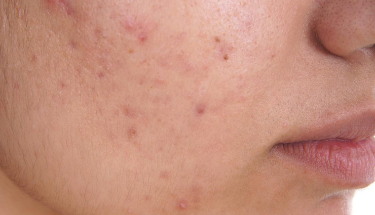 skin issues,skin treatment,food for healthy skin,skin care tips,beauty tips,beauty