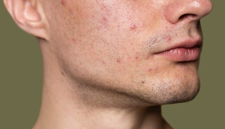 natural tips for mens to treat oily skin,beauty tips,beauty hacks