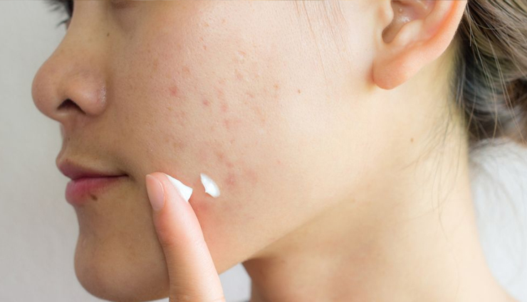 acne free skin,diy hibiscus and rose face cream,rose face cream,acne cream,diy cream for acne,beauty,beauty tips