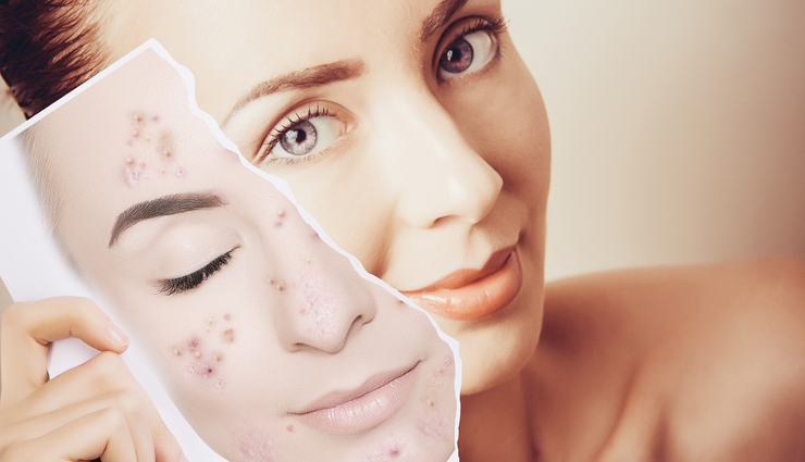 11 Effective and Natural Ways To Treat Acne