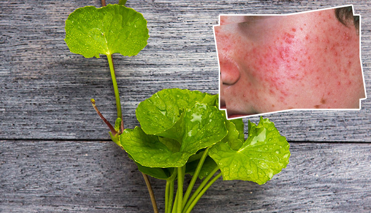  8 DIY Gotu Kola Masks for Acne-Free Skin