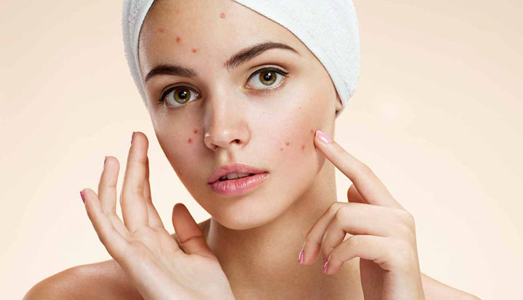home remedies,home remedies for acne marks,acne marks,skin care tips,beauty tips