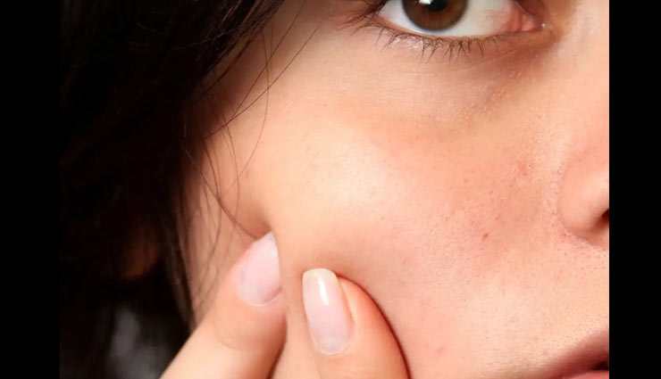 home remedies,home remedies for acne marks,acne marks,skin care tips,beauty tips