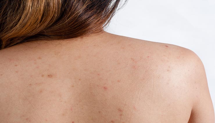 पीठ के एक्ने की वजह से नहीं पहन पा रहे हैं बेकलेस ब्लाउज, इन उपायों की मदद से दूर करें यह परेशानी