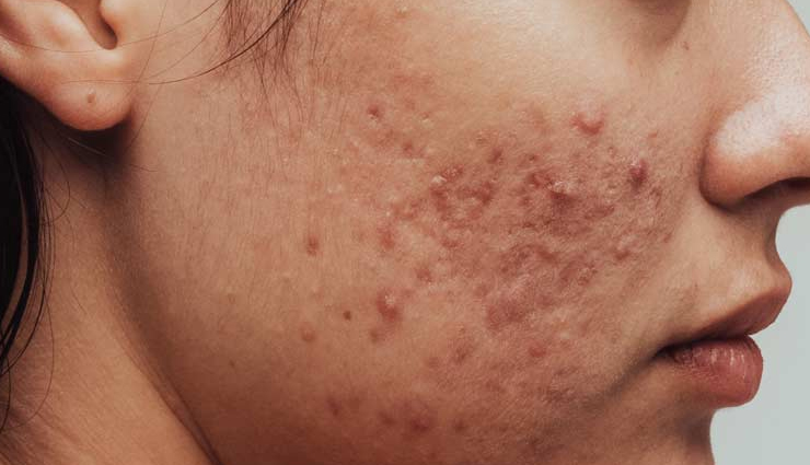 diy tea tree oil skin care,tea tree oil for acne,tea tree oil face mask,tea tree oil toner recipe,tea tree oil for oily skin,natural skin care with tea tree oil,tea tree oil for inflammation,tea tree oil diy treatments,tea tree oil for pore cleansing,tea tree oil benefits for skin