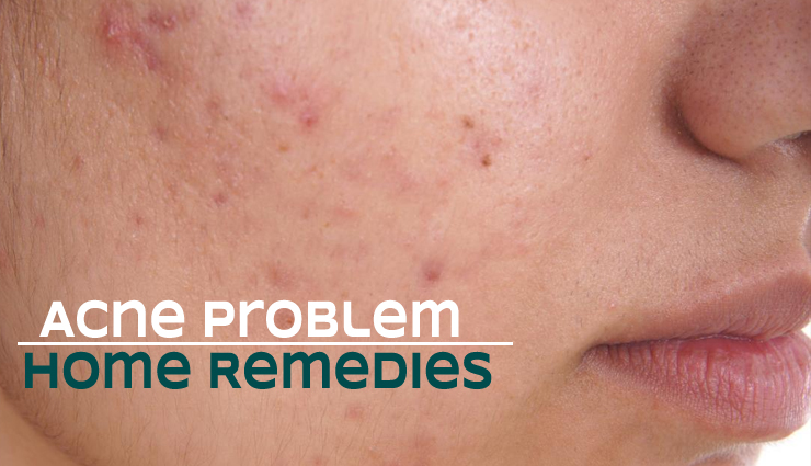 Home Remedies To Treat Acne