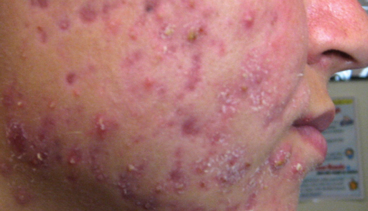 vitamin d deficiency skin problems,effects of low vitamin d on skin,vitamin d and acne breakouts,hair issues from vitamin d deficiency,signs of vitamin d deficiency on skin,vitamin d deficiency and aging,how vitamin d affects nails and skin