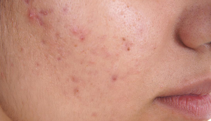 11 Home Remedies To Prevent Acne Safely and Effectively