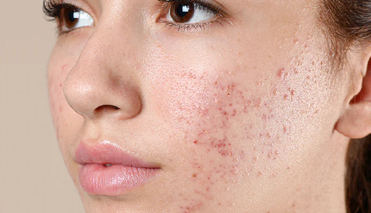 7 DIY Remedies To Treat Acne Prone Skin During Summers