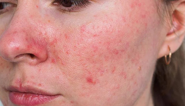 5 Ways To Treat Acne Using Green Tea