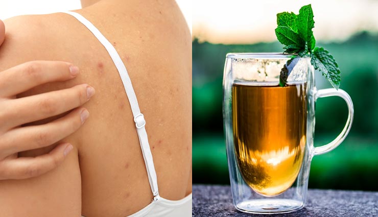 beauty tips,beauty tips in hindi,remove acne from back,home remedies,skin care tips