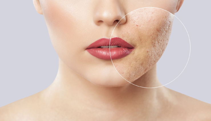 home remedies to get rid of acne scars,acne scars,home remedies,skin care tips,beauty tips,summer tips