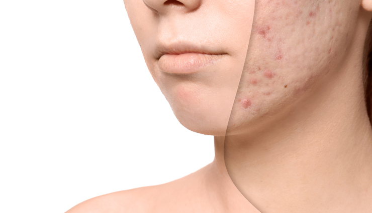 5 Home Remedies To Get Rid of Acne Scars
