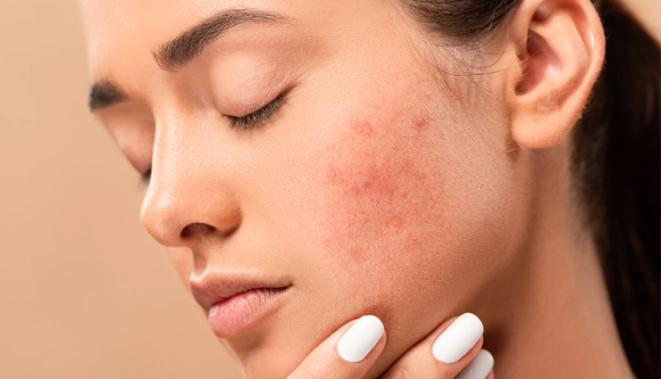 tea tree oil,tea tree oil treat acne,acne,acne problem,simple ways to treat acne,skin care tips,beauty tips,beauty