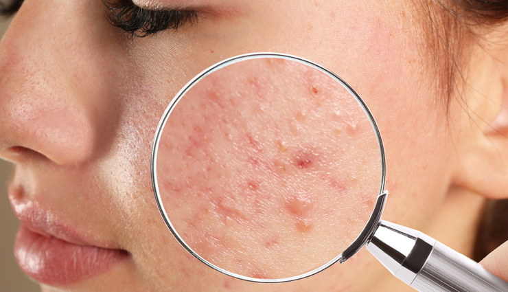 7 Remedies To Get Rid of Acne Scars Naturally at Home