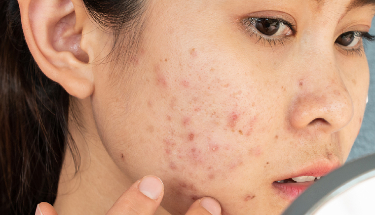 8 Treatment You Can Try To Get Acne Free Skin