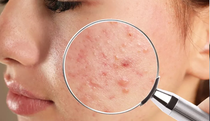 9 Effective Home Remedies To Treat Acne Scars