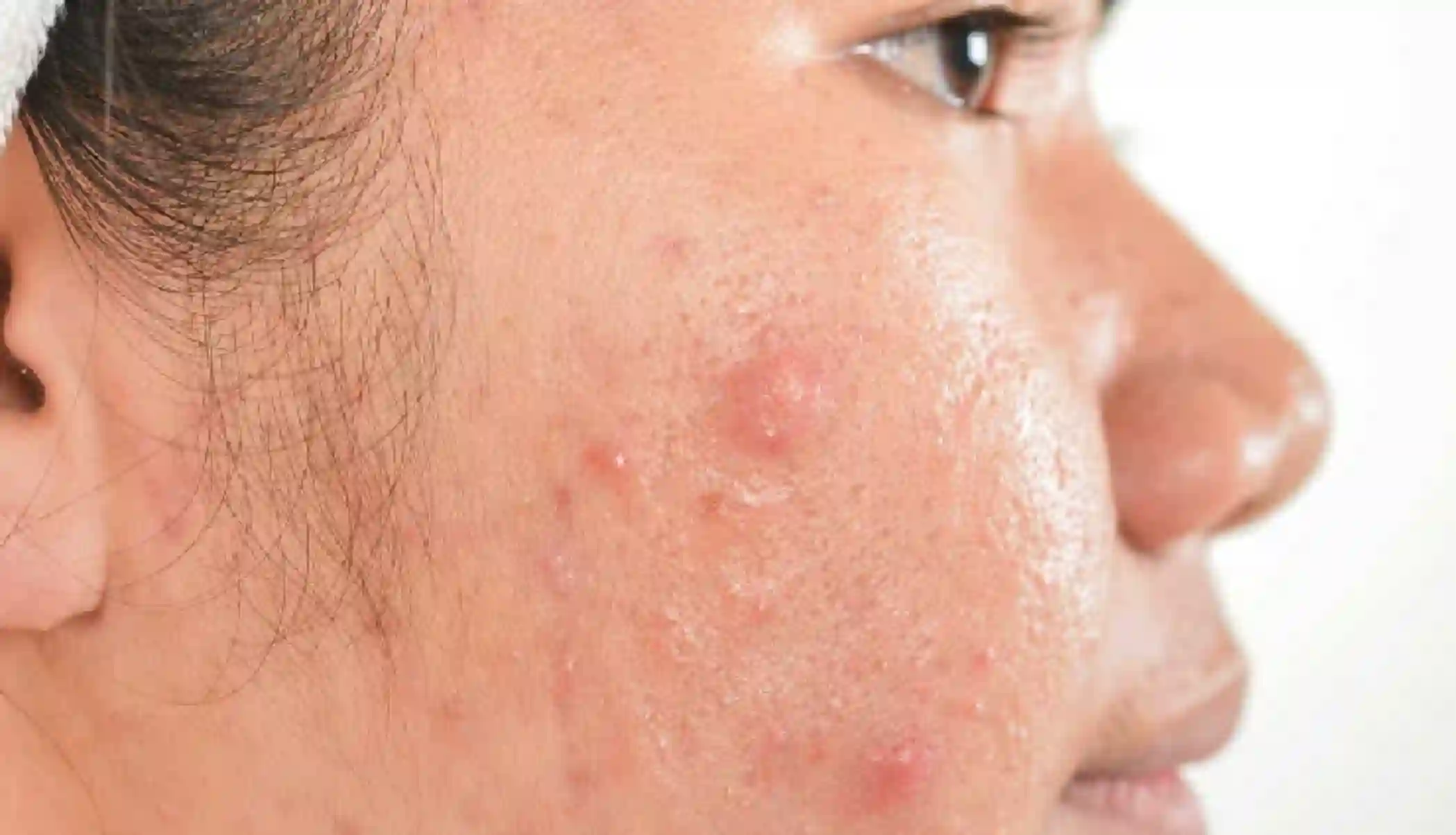 8 DIY Ways To Treat Acne Spots