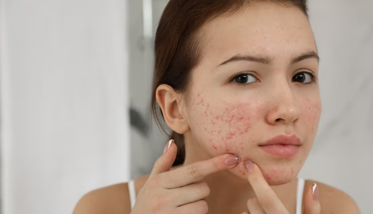 acne-free skin solutions,tips for acne-free skin,how to clear acne,natural acne remedies,skincare routine for acne,clear skin treatments,prevent acne breakouts,glowing skin solutions,home remedies for acne,best products for acne-free skin.
