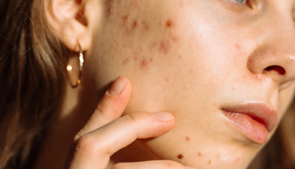 8 Natural Home Remedies You Can Try To Treat Acne Spots