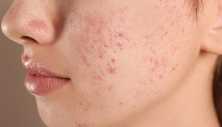 diy gram flour face masks,benefits of gram flour for skin,gram flour skincare,besan for glowing skin,natural face masks with gram flour,gram flour for acne,besan face pack,gram flour skin brightening,homemade gram flour scrub,anti-tan remedies with gram flour