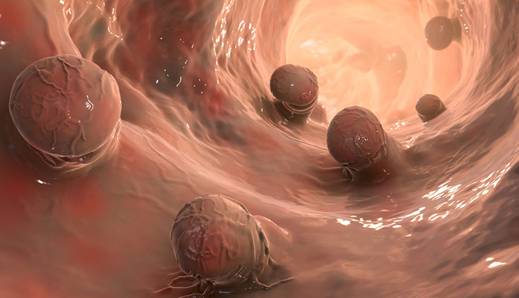 early signs of bowel cancer,symptoms of colorectal cancer,bowel cancer warning signs,blood in stools bowel cancer,abdominal pain cancer symptom,unexplained weight loss cancer,bowel cancer detection,colorectal cancer symptoms,early bowel cancer indicators,when to see a doctor for bowel issues