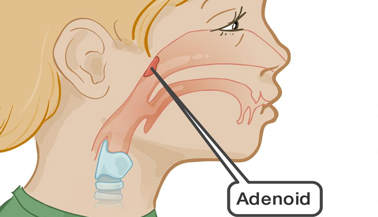 blocked nose,causes of blocked nose,major causes of blocked nose,nose care,nose treatment,Health,Health tips