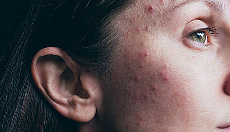5 Tried and Tested Ways To Get Rid of Adult Acne
