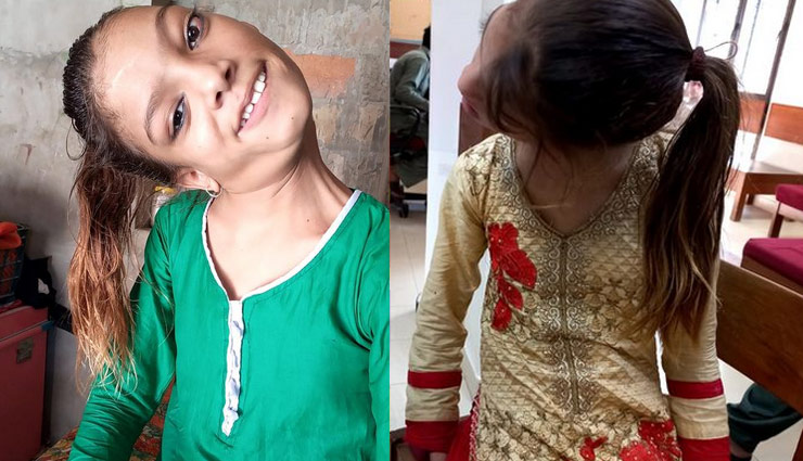 90 डिग्री मुड़ी थी पाकिस्तानी बच्ची की गर्दन, 13 साल बाद सर्जरी से बदल गई लाइफ 