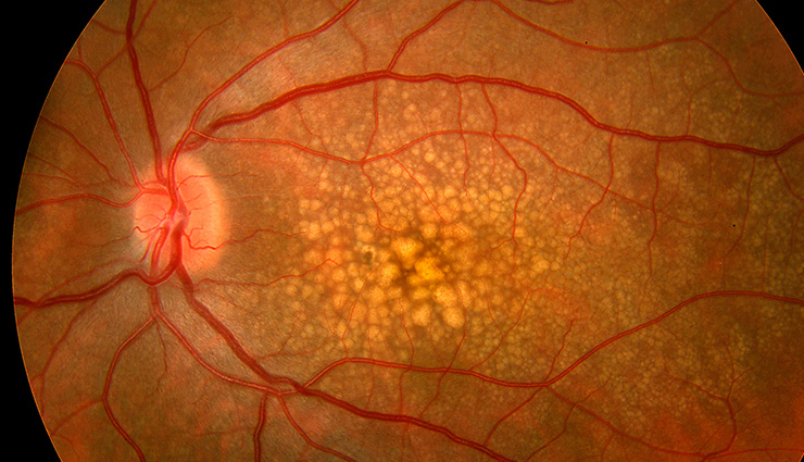world no tobacco day,tobacco impact on eyes,smoking and eye health,cataracts and smoking,age-related macular degeneration (amd) and smoking,dry eye syndrome and smoking,optic neuropathy and smoking,uveitis and smoking,graves ophthalmopathy and smoking,tobacco-related eye diseases