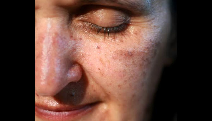 age spots,remedies to reduce age spots,skin care tips,beauty tips