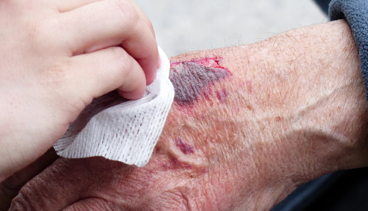 wound healing factors,impact of overall health on wounds,age and wound healing,obesitys effect on wound healing,trauma type and healing rate,importance of skin moisture in healing,chronic conditions and wound recovery,medications affecting wound healing,proper wound care techniques,strategies for faster wound healing,maintaining skin moisture for healing,delayed healing due to medications,managing chronic conditions for wound recovery