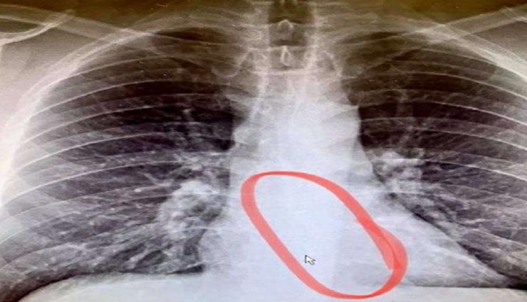 शख्स के साथ नींद में हुआ कुछ ऐसा कि लेनी पड़ी डॉक्टर की मदद, कराया ऑपरेशन