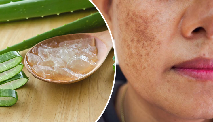 6 DIY Aloe Vera Masks for Hyperpigmentation
