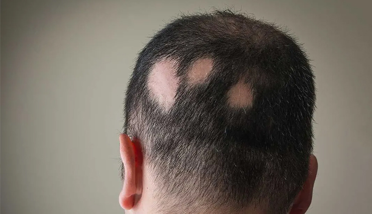 cedarwood oil benefits for hair,beauty tips,beauty hacks,hair care tips,cedarwood oil,benefits for hair,cedarwood oil benefits for beard,cedarwood oil uses and benefits,cedarwood oil,cedarwood essential oil benefits,cedarwood oil health benefits