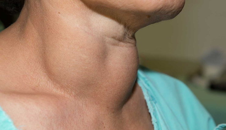 world thyroid day,natural alternatives for hypothyroidism,Health tips,fitness tips,thyroid care tips