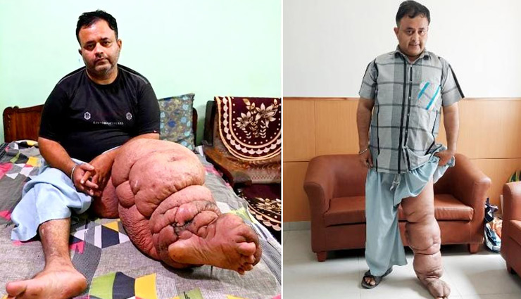 दुर्लभ बीमारी के चलते 50 किलो का हो गया था पैर, 25 डॉक्टरों की टीम ने की सफल सर्जरी