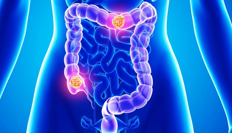 anaplastic thyroid cancer,small bowel adenocarcinoma,fibrolamellar hepatocellular carcinoma,gynaecological sarcoma,salivary gland cancer,thymoma,penile cancer,relapsed metastatic anal cancer,ocular melanoma