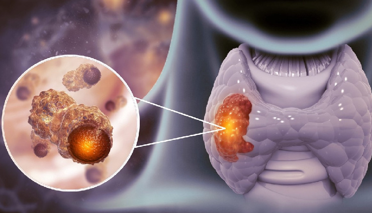 anaplastic thyroid cancer,small bowel adenocarcinoma,fibrolamellar hepatocellular carcinoma,gynaecological sarcoma,salivary gland cancer,thymoma,penile cancer,relapsed metastatic anal cancer,ocular melanoma