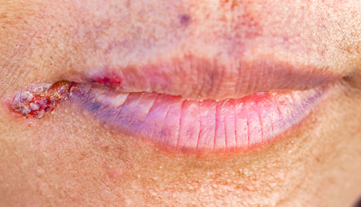 13 Remedies To Treat Angular Cheilitis at Home