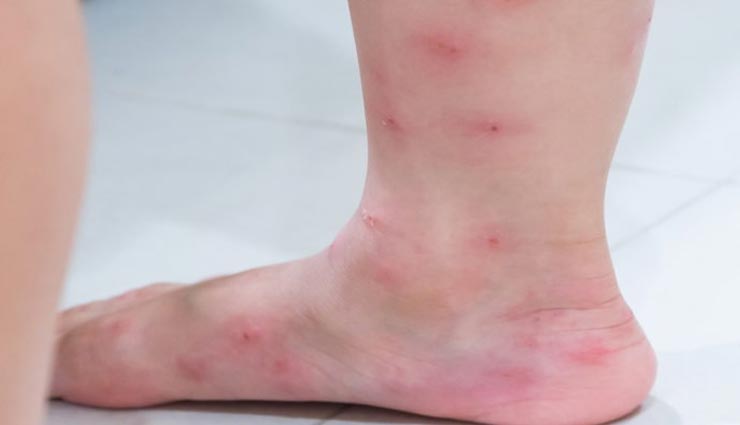 Health tips,health tips in hindi,home remedies treatment,treatment on animal bite