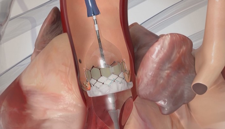 aortic stenosis,aortic valve narrowing,heart valve disease,aortic stenosis symptoms,causes of aortic stenosis,aortic stenosis diagnosis,aortic stenosis treatment,preventing aortic stenosis,aortic stenosis risk factors,aortic valve replacement